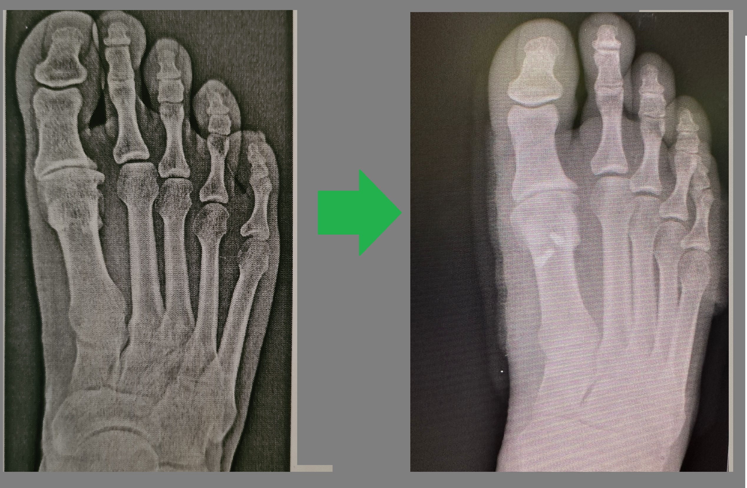 Hallux Rigidus (остеоартроз первого плюснефалангового сустава)